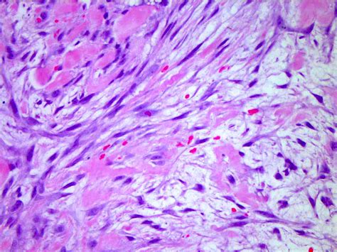 noduläre fasziitis|Nodular fasciitis pathology